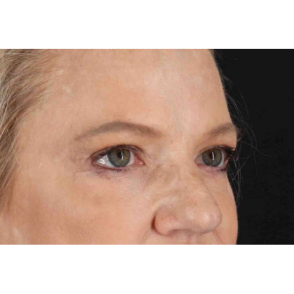 Brow Lift Before & After Patient #10848