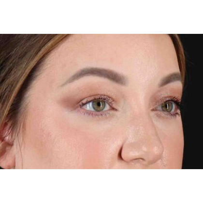 Brow Lift Before & After Patient #10837