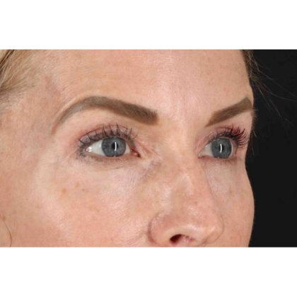 CO2 Laser Before & After Patient #10551