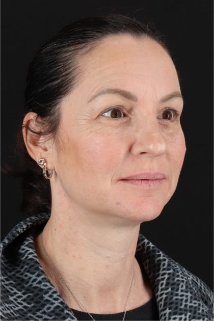 Chemical Peels Before & After Patient #11418