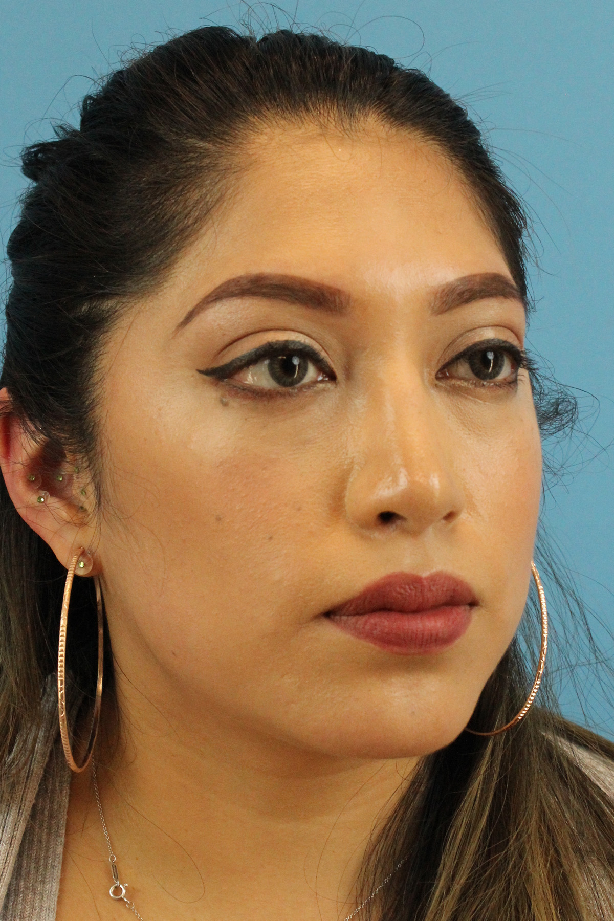 Chin Implant Before & After Patient #13673