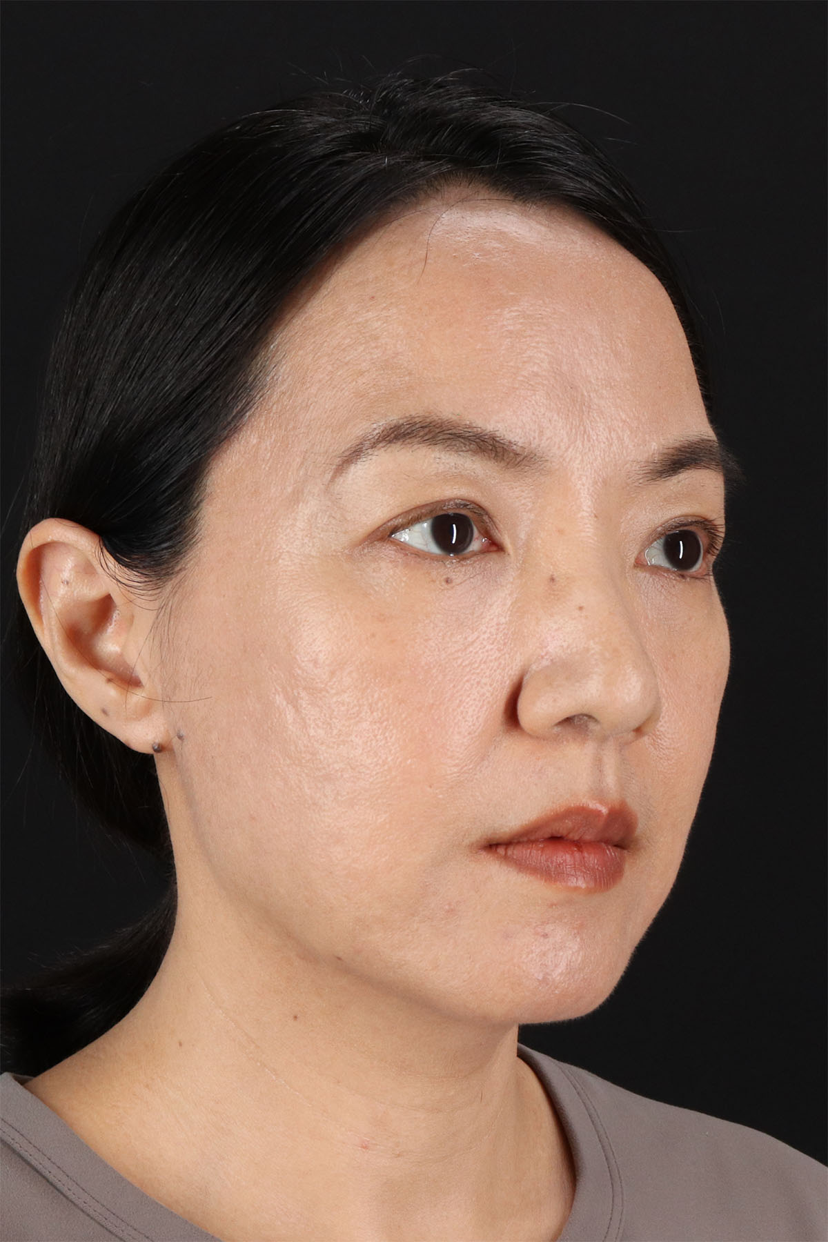 CO2 Laser Before & After Patient #11059