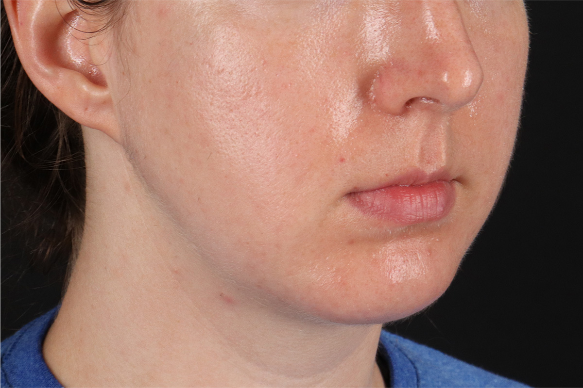 Chin Implant Before & After Patient #13761