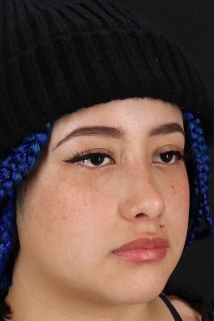 Rhinoplasty Before & After Patient #12491