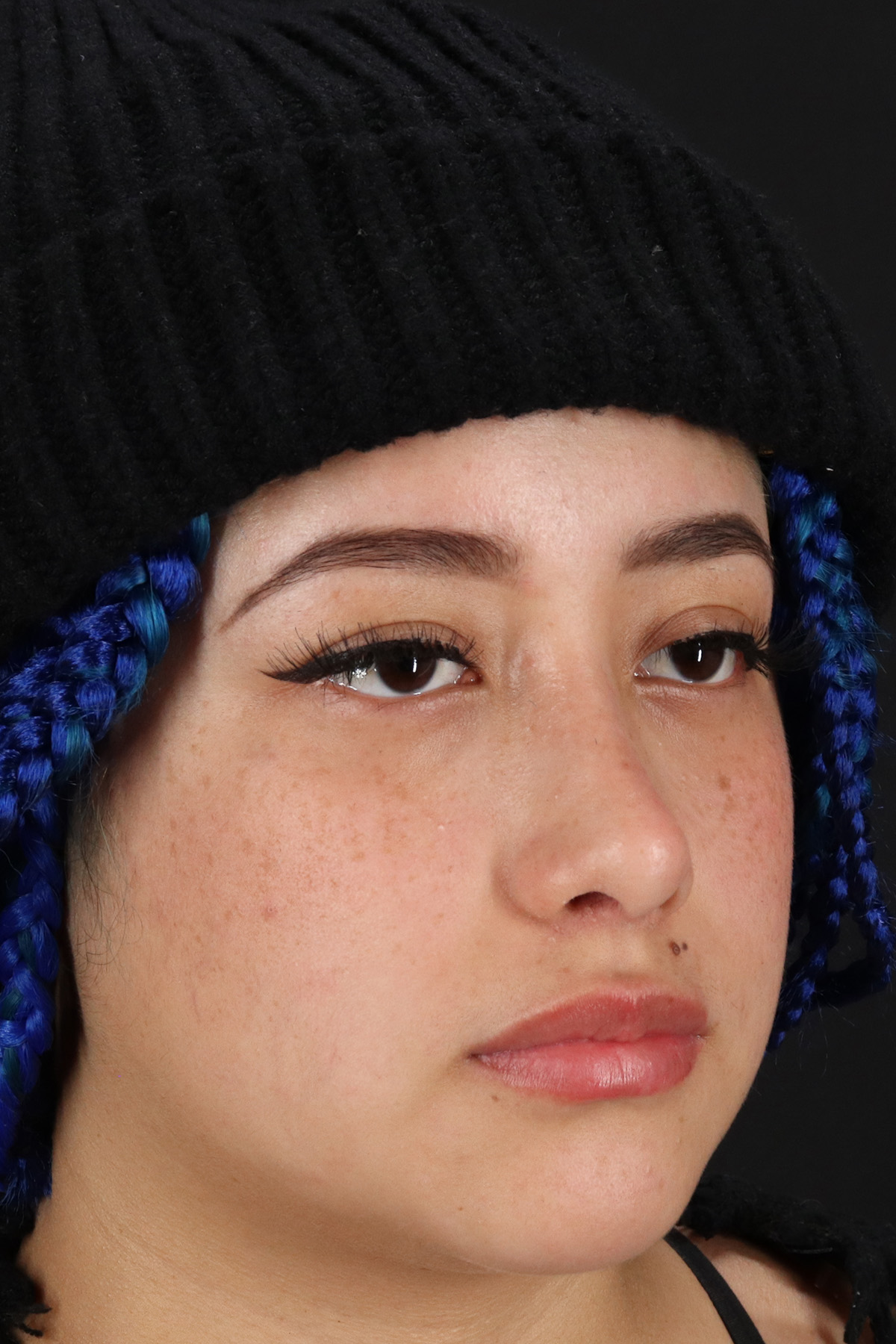 Rhinoplasty Before & After Patient #12491