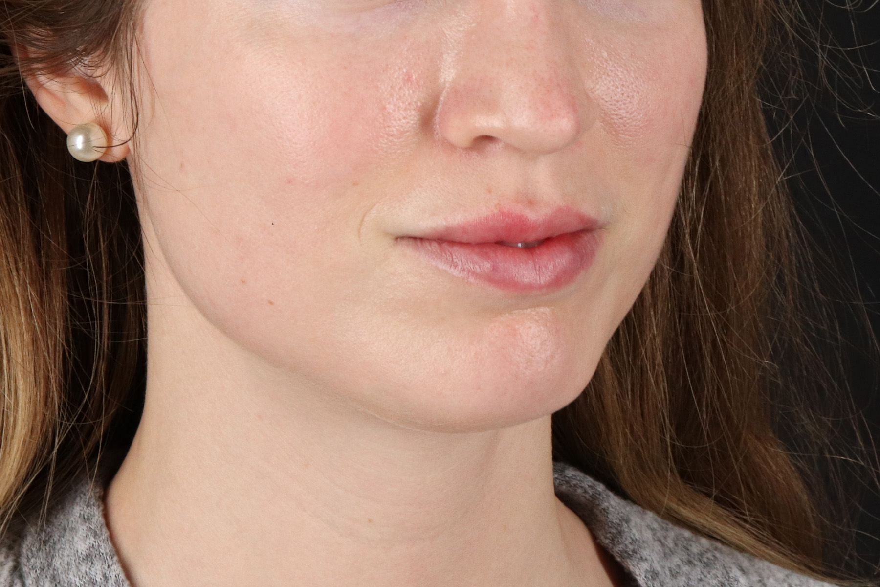 Buccal Fat Pad Before & After Patient #14025
