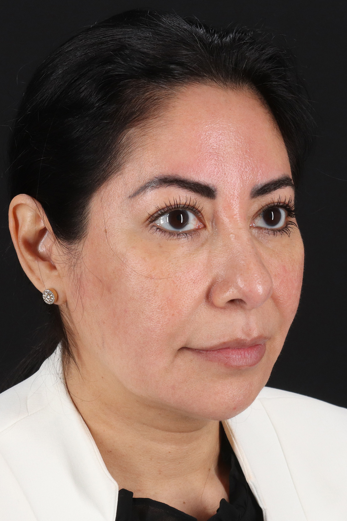 Buccal Fat Pad Before & After Patient #14014
