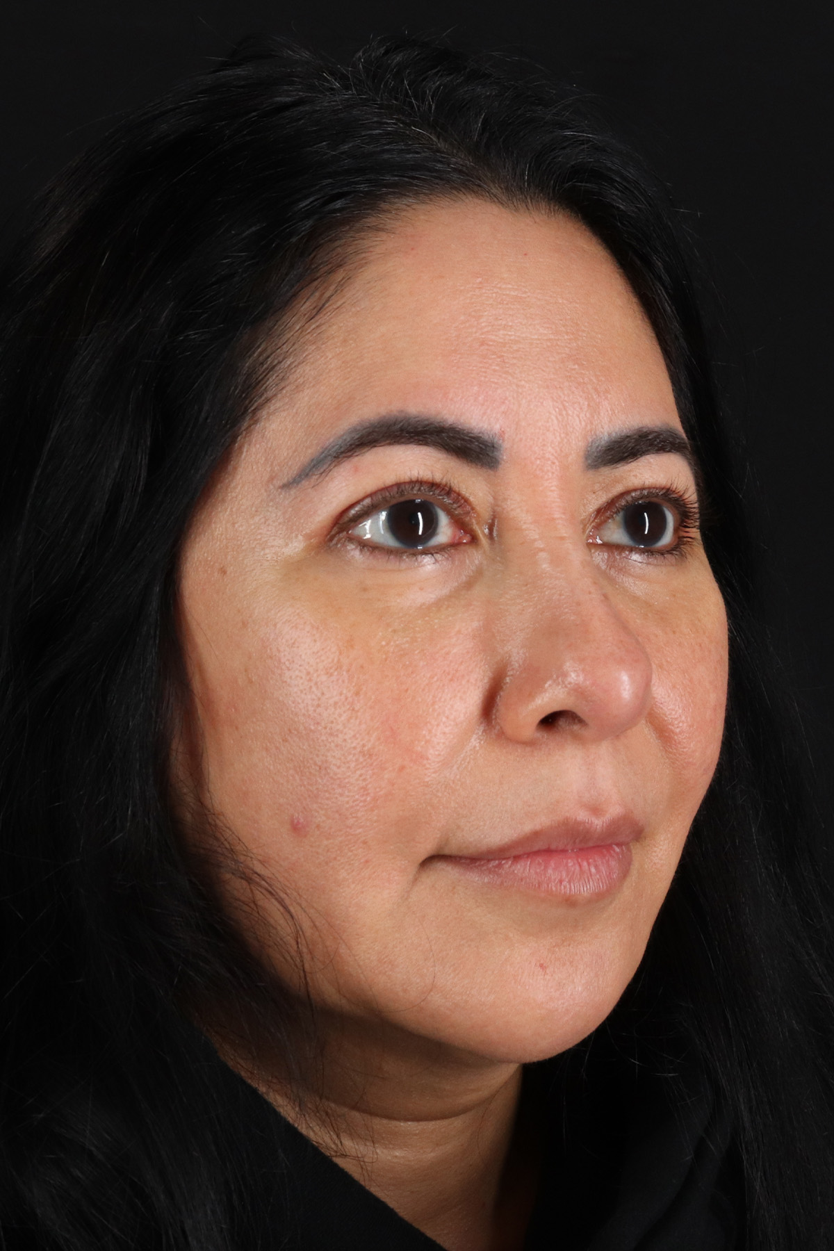 Upper Blepharoplasty Before & After Patient #12062