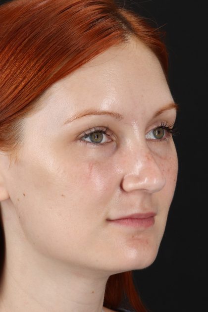 Lower Blepharoplasty Before & After Patient #13008