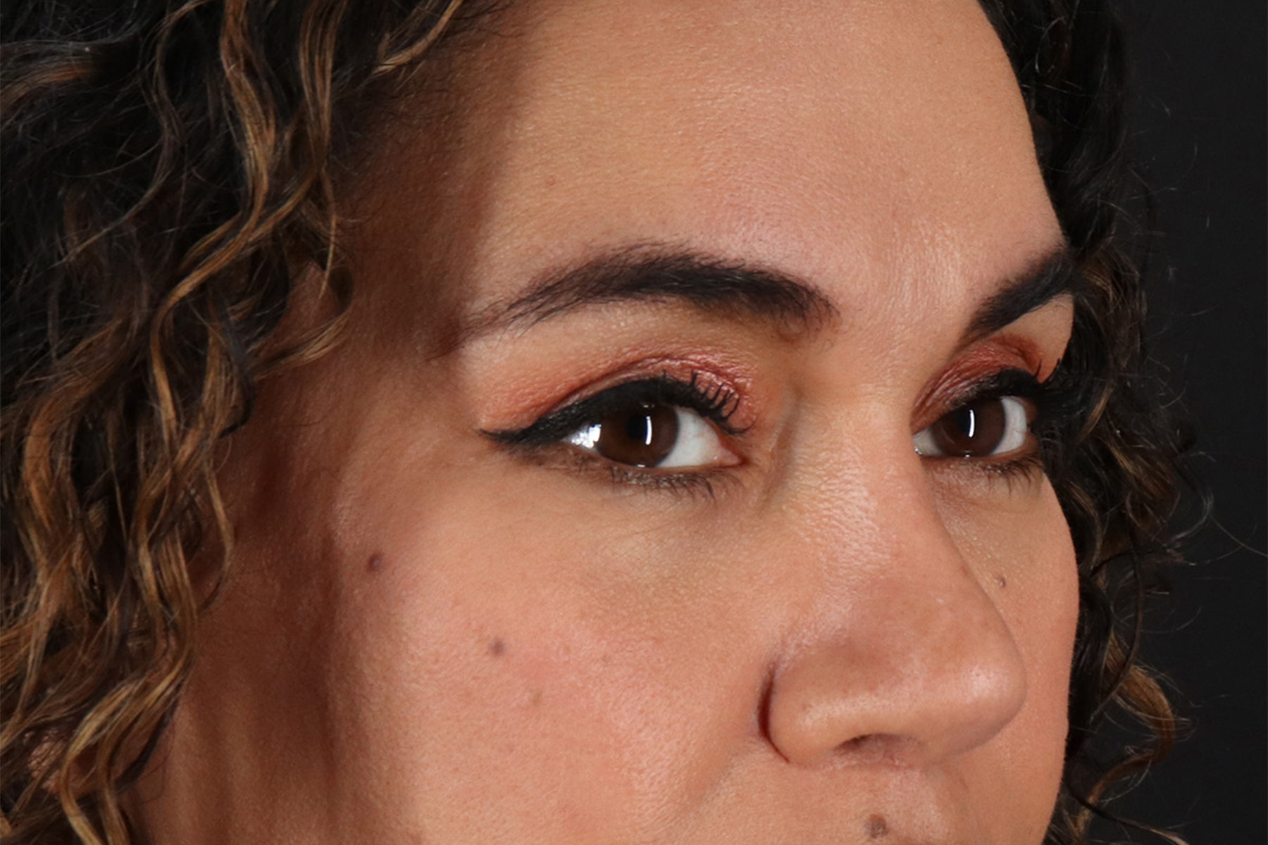 Upper Blepharoplasty Before & After Patient #12007