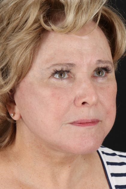 Facelift Before & After Patient #11695