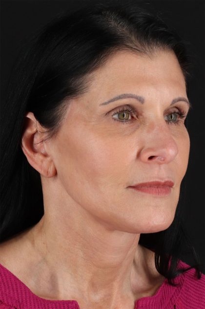 Neck Lift Before & After Patient #12887
