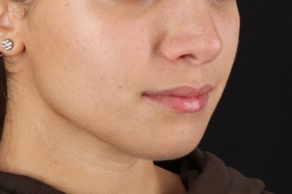 Chin Implant Before & After Patient #13750