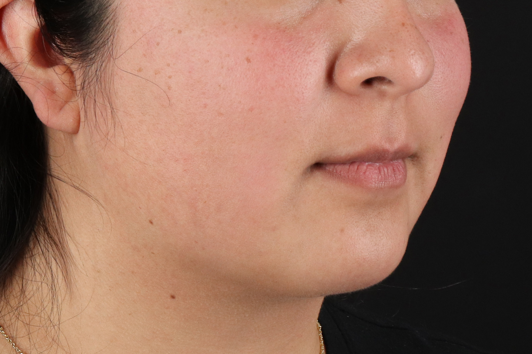Neck Liposuction Before & After Patient #12106