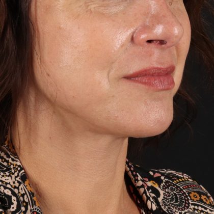 Neck Lift Before & After Patient #12953