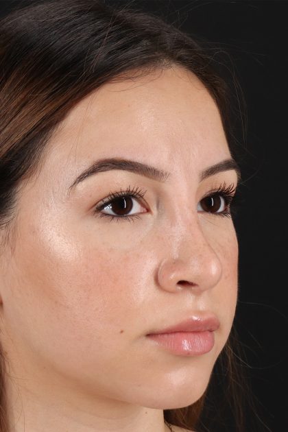 Rhinoplasty Before & After Patient #12271