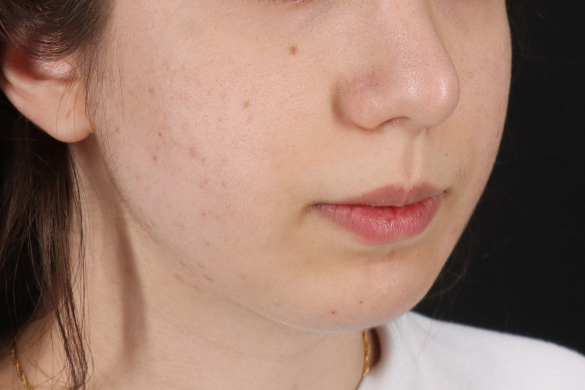 Chin Implant Before & After Patient #13772