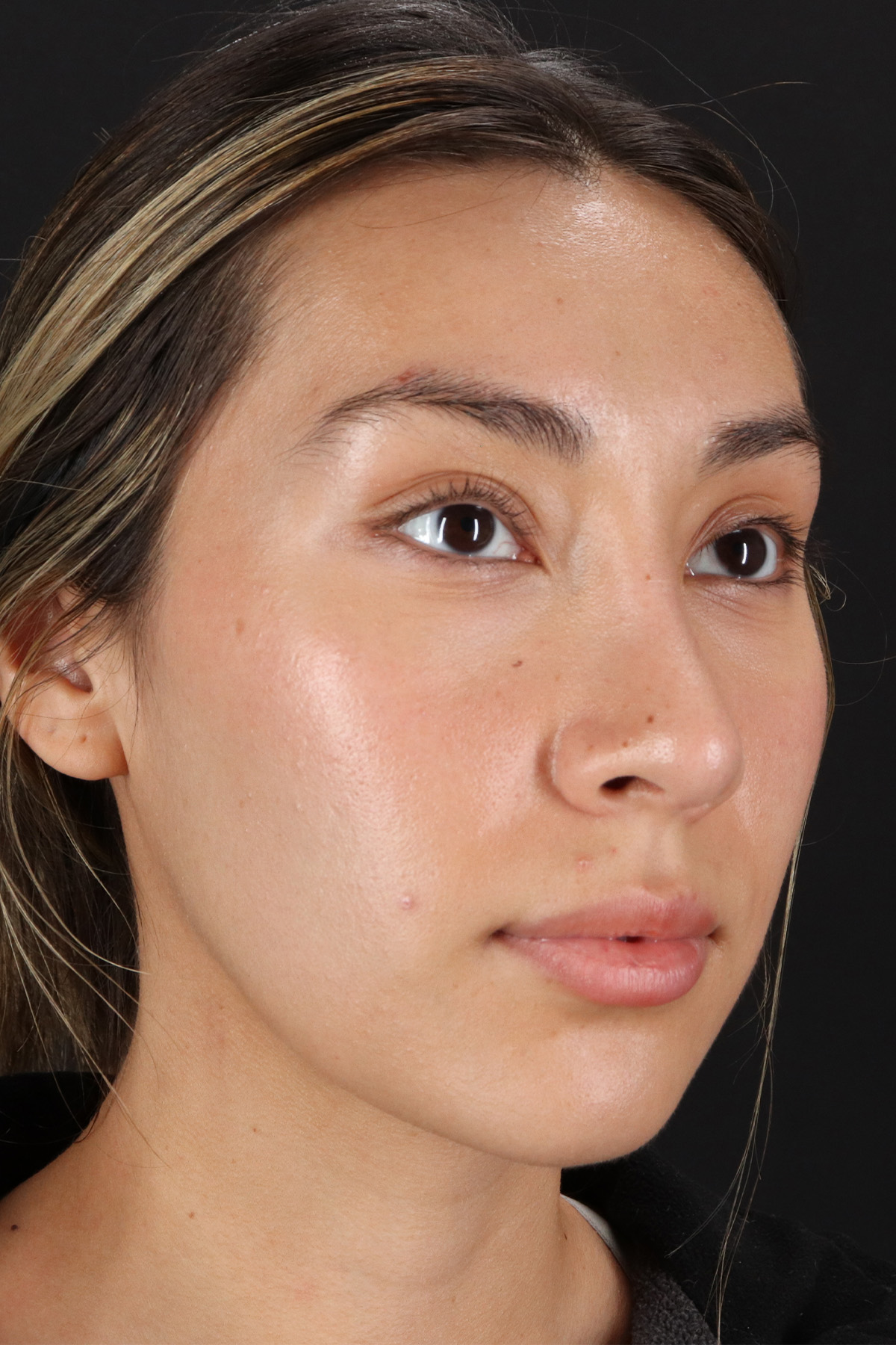 Rhinoplasty Before & After Patient #12480