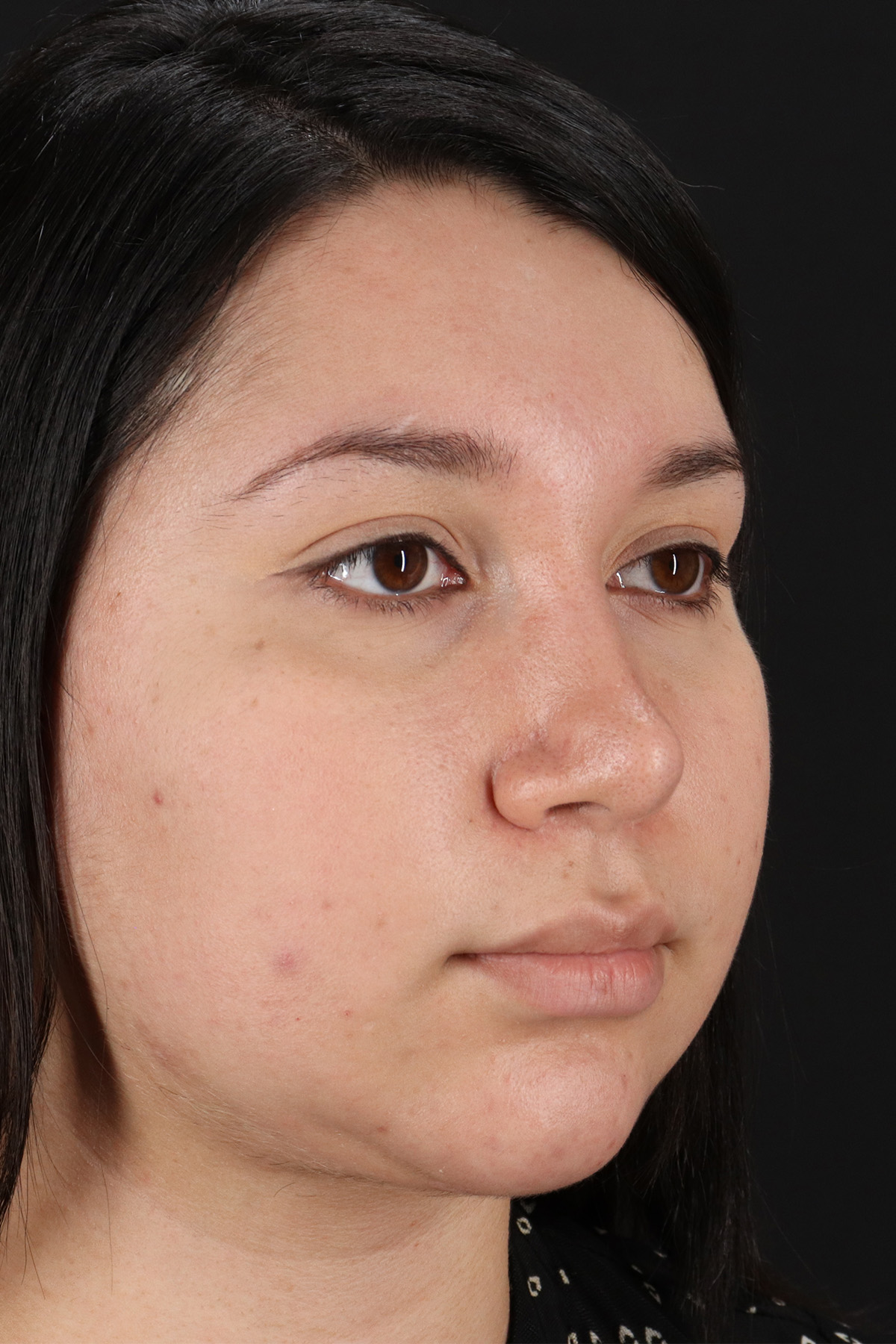 Chin Implant Before & After Patient #13739