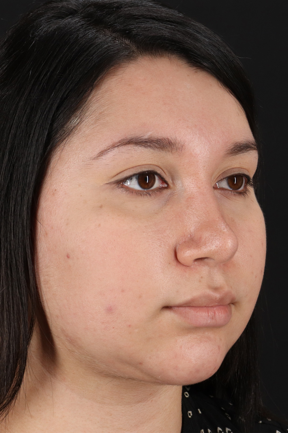 Neck Lift Before & After Patient #11698