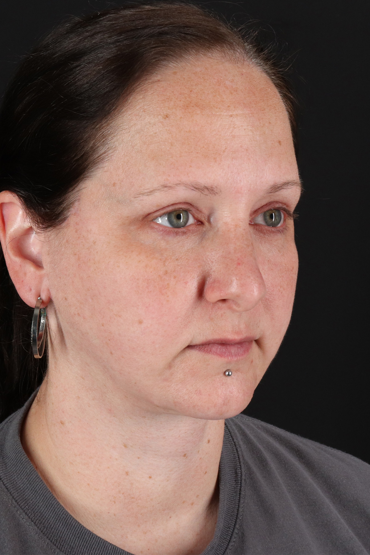 Lower Blepharoplasty Before & After Patient #13052