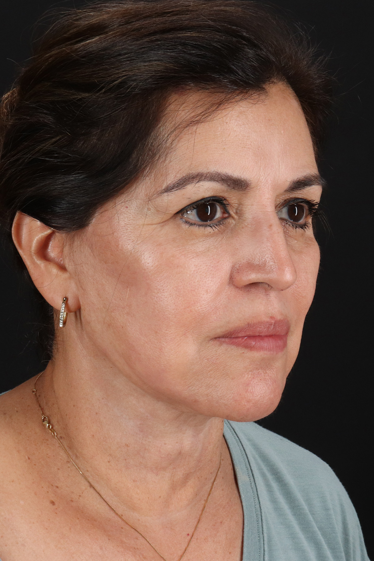 Lower Blepharoplasty Before & After Patient #13063