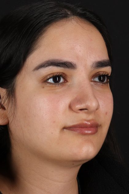 Rhinoplasty Before & After Patient #12436