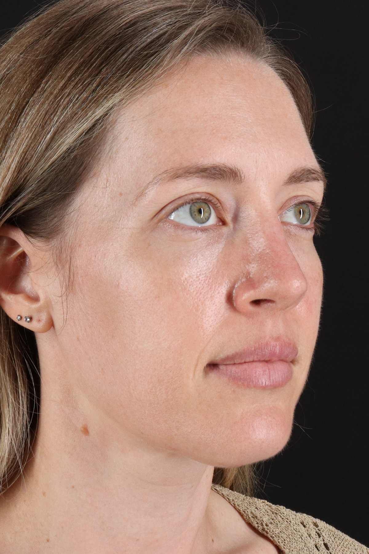 Rhinoplasty Before & After Patient #12227