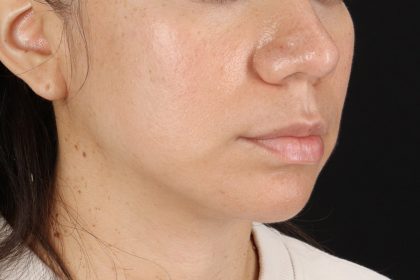 Chin Implant Before & After Patient #13783