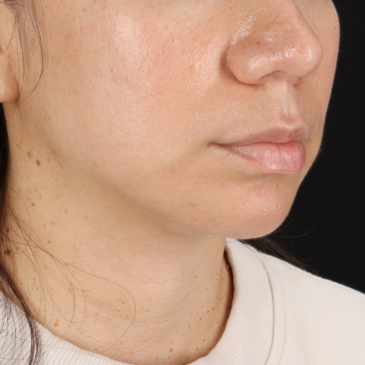 Facelift Before & After Patient #11699