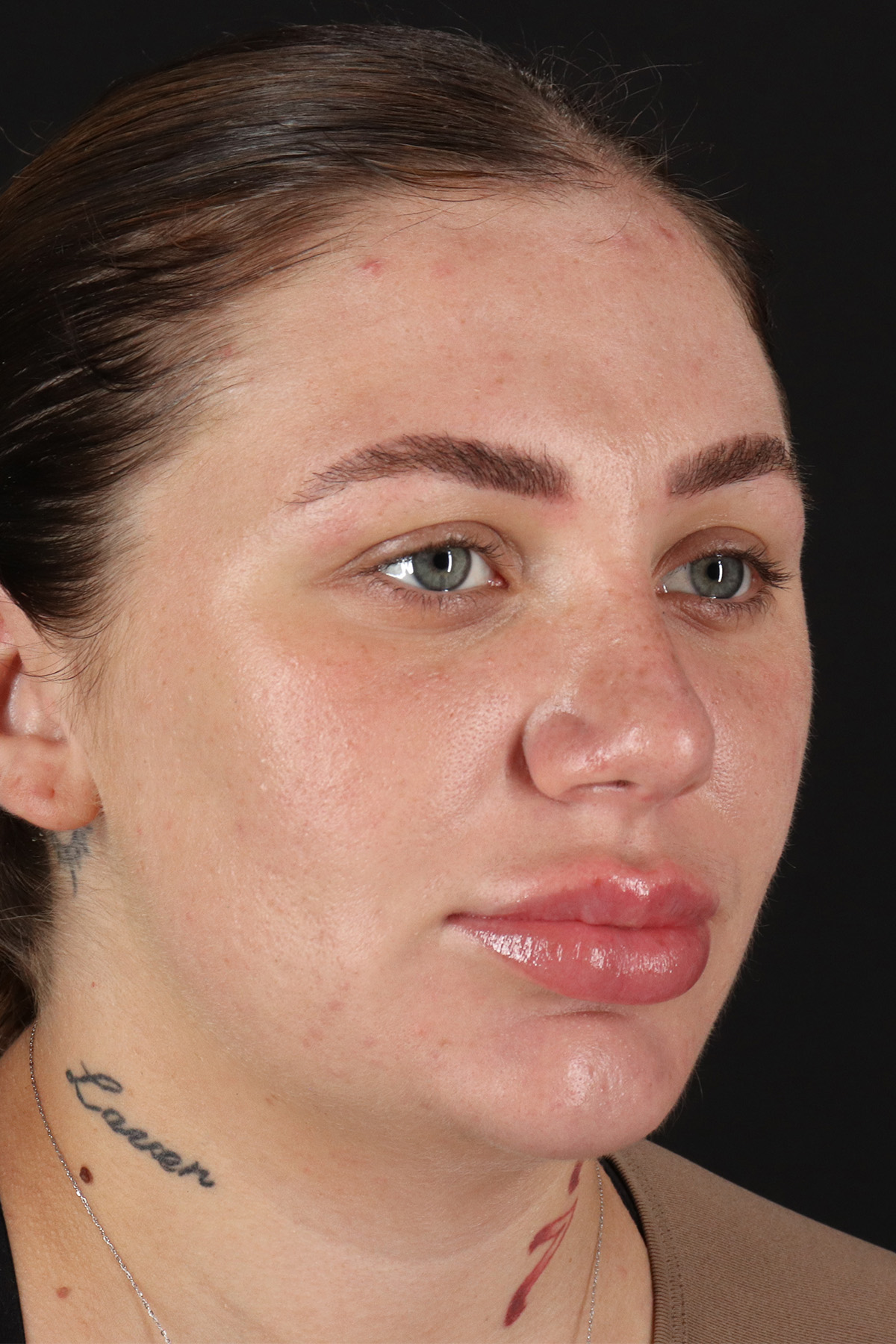 Rhinoplasty Before & After Patient #12403