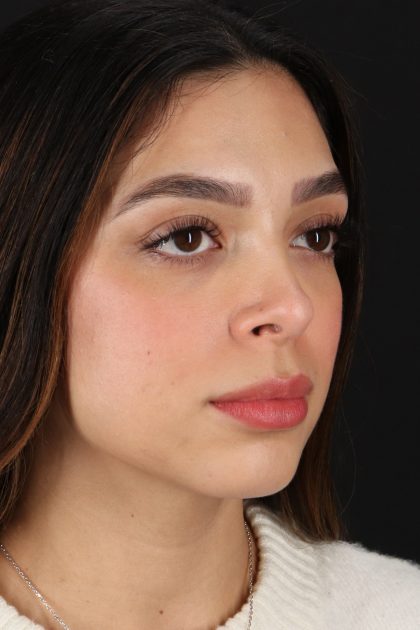 Rhinoplasty Before & After Patient #12249