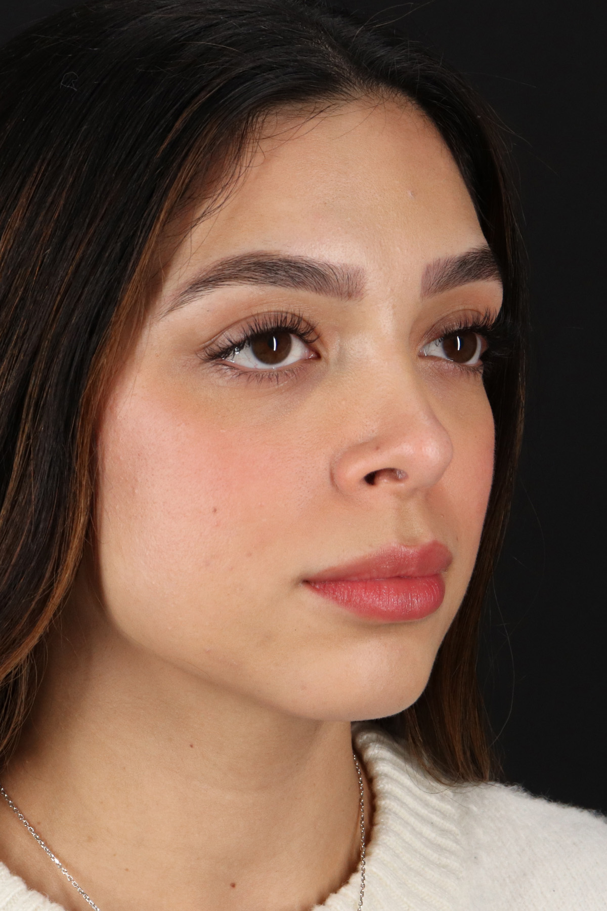 Rhinoplasty Before & After Patient #12249