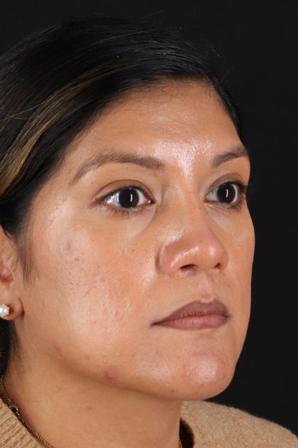 Rhinoplasty Before & After Patient #12337