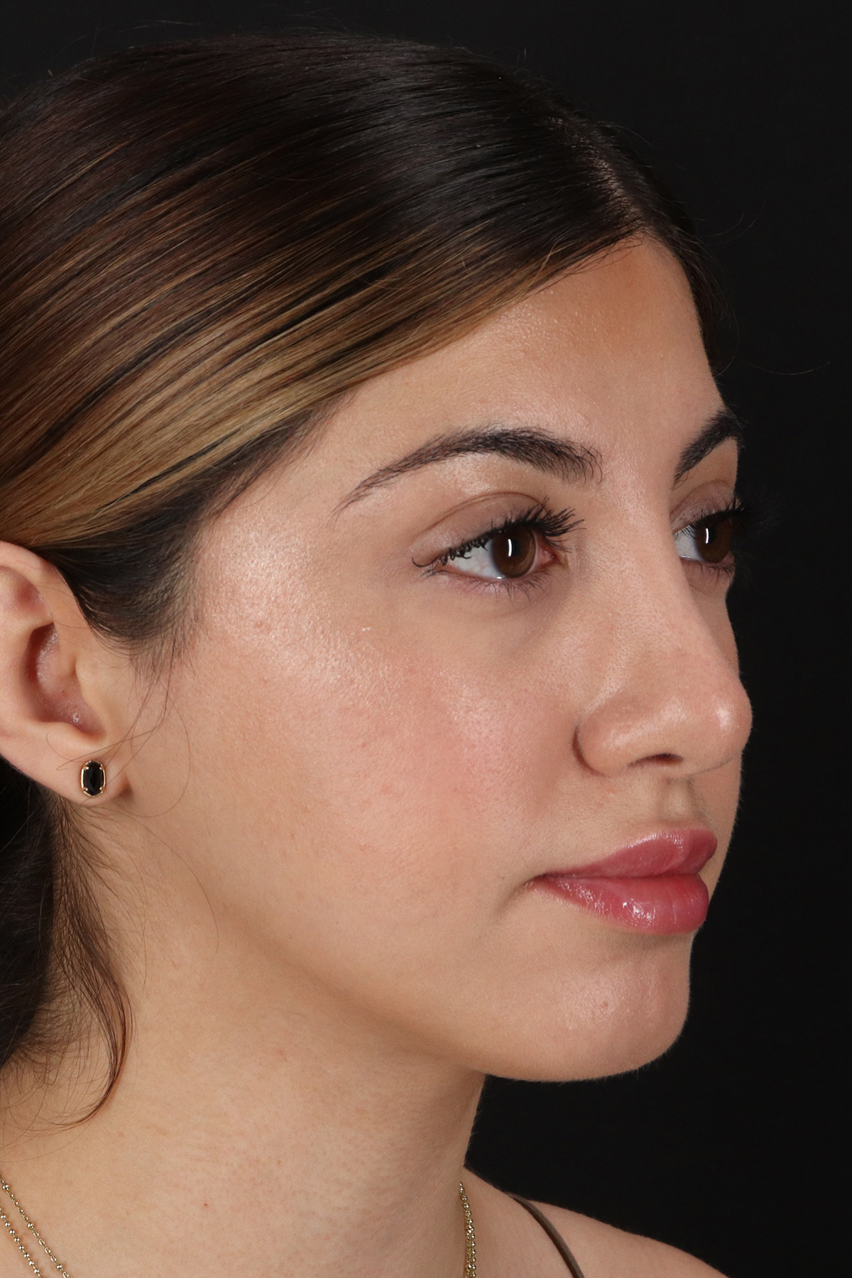 Rhinoplasty Before & After Patient #12304
