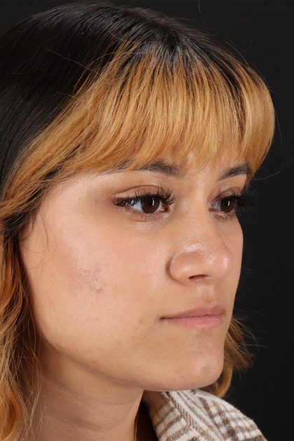 Rhinoplasty Before & After Patient #12469