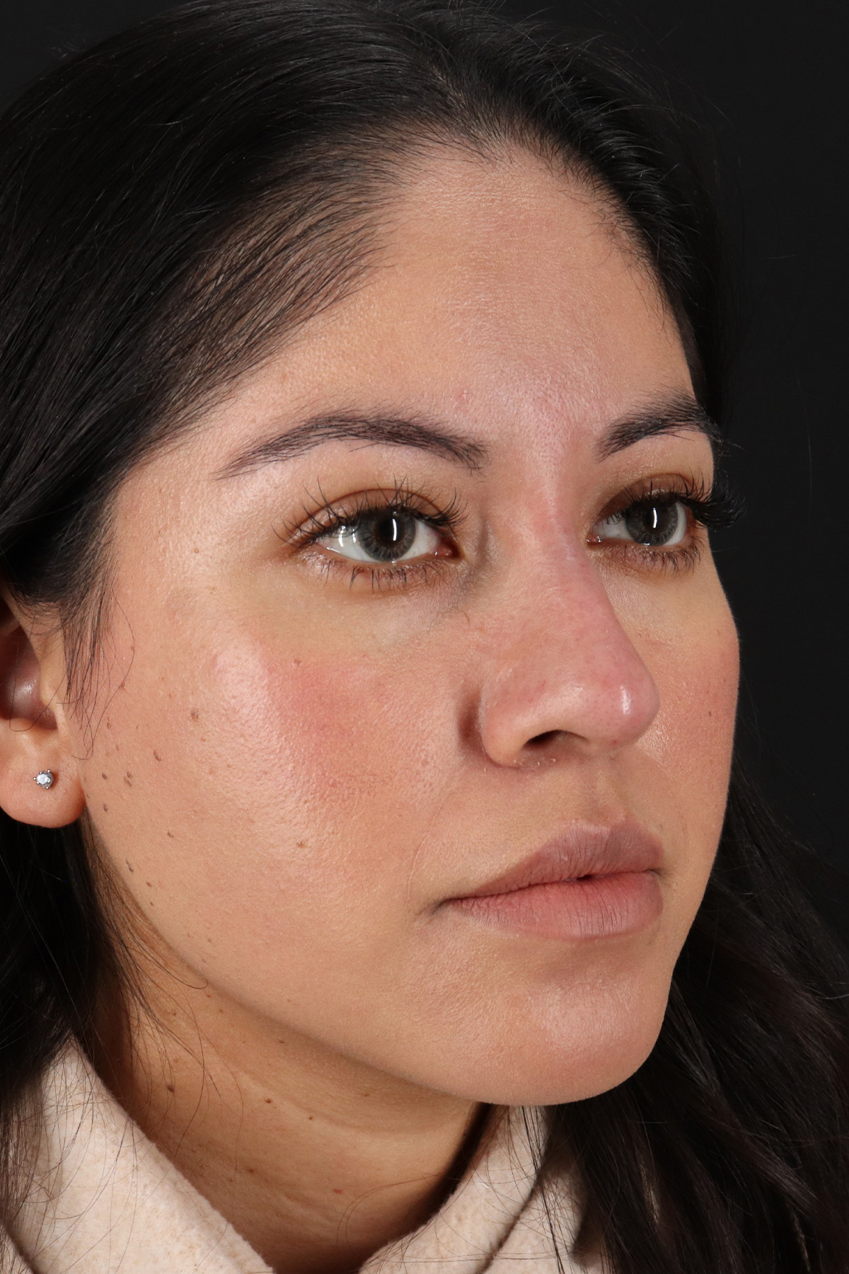 Fillers Before & After Patient #13276