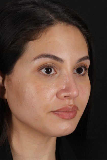 Rhinoplasty Before & After Patient #12282