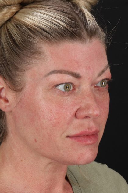Lower Blepharoplasty Before & After Patient #13030