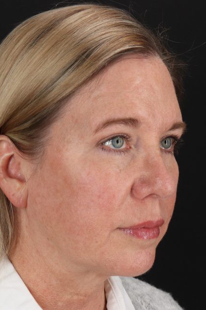 Lower Blepharoplasty Before & After Patient #13041