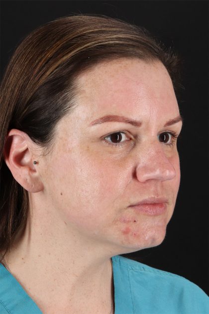 Chemical Peels Before & After Patient #11070
