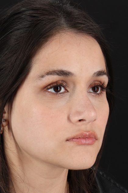 Rhinoplasty Before & After Patient #12260