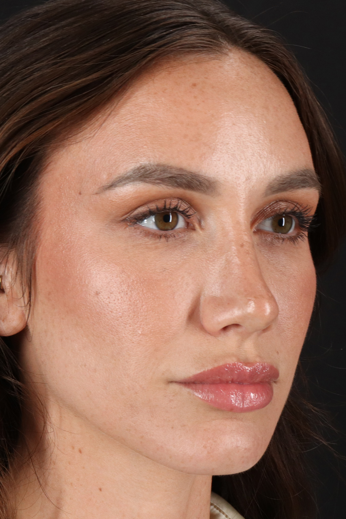 Rhinoplasty Before & After Patient #12370