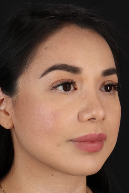 Chin Implant Before & After Patient #13717