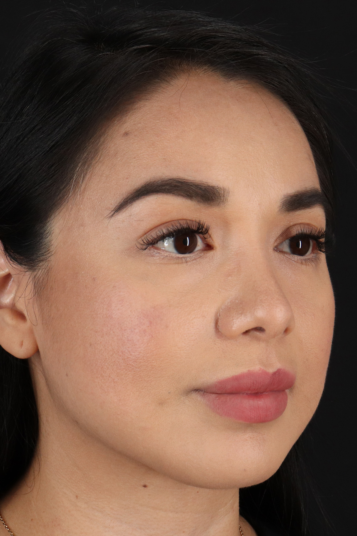 Chin Implant Before & After Patient #13717