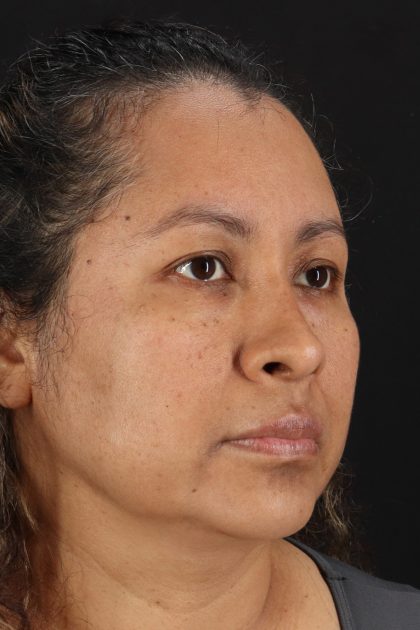 Rhinoplasty Before & After Patient #12293