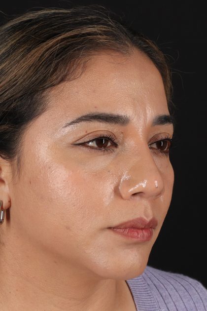 Rhinoplasty Before & After Patient #12425