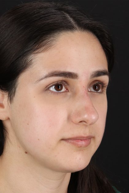 Liquid Rhinoplasty Before & After Patient #11339