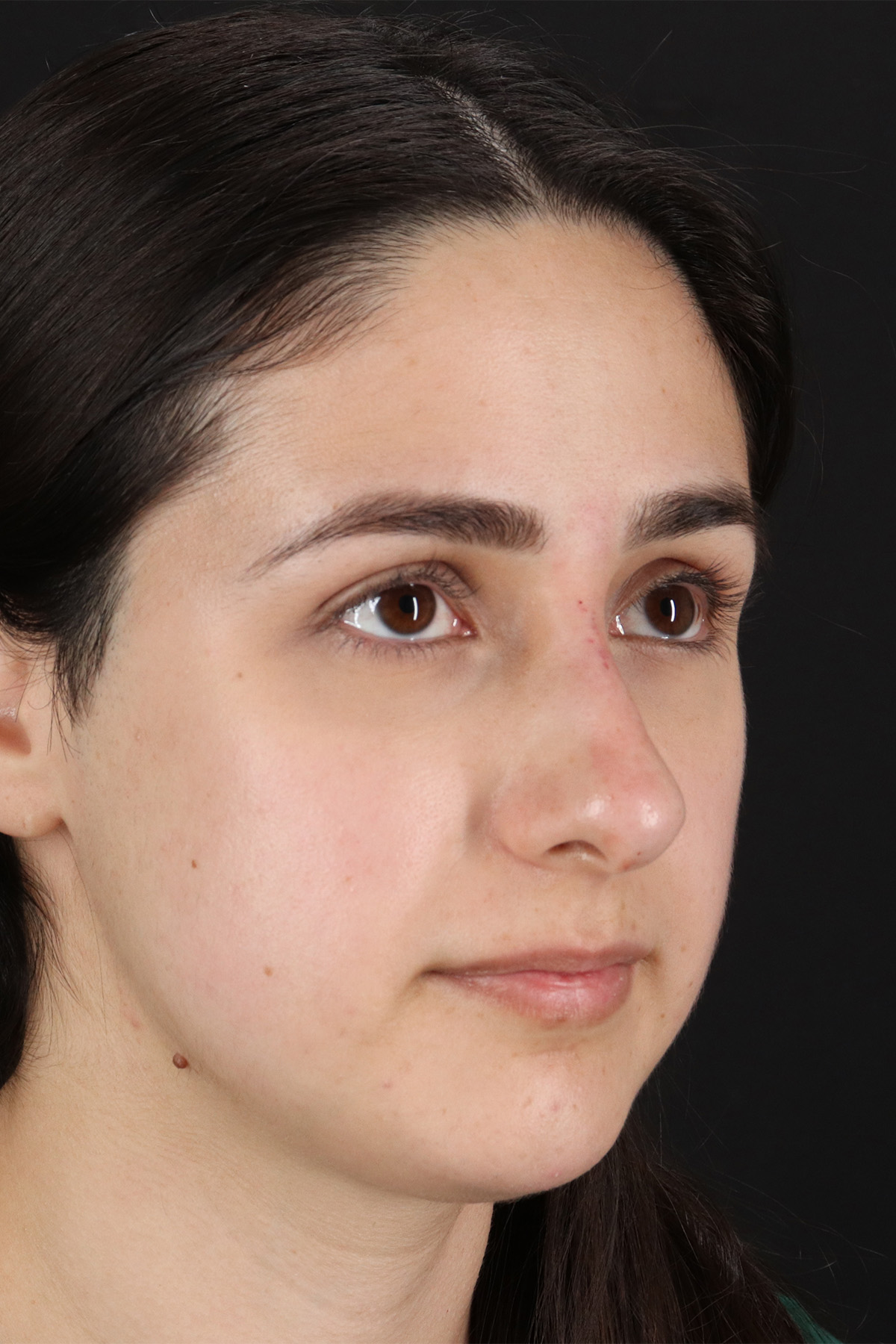 Liquid Rhinoplasty Before & After Patient #11339
