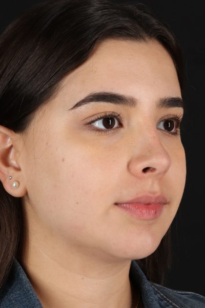 Chin Implant Before & After Patient #11694